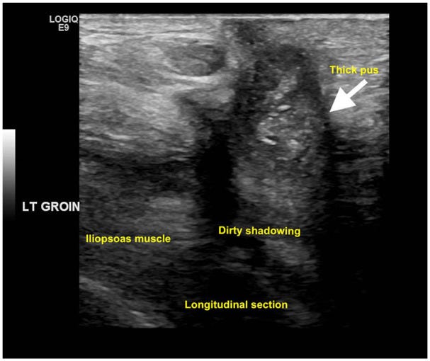 Hernia parte V Ecografia tempo formacion.jpg